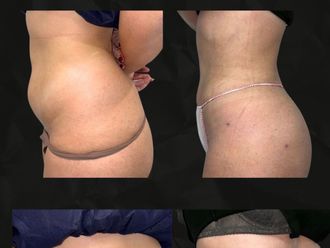 Liposucción antes y después - 879883