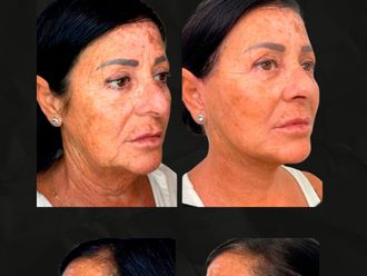 Lifting antes y después - 879884