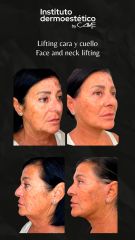 Lifting cara y cuello
