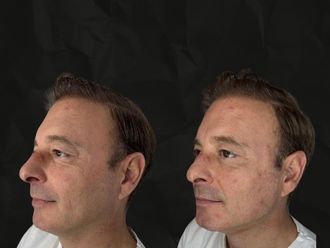 Marcación mandibular antes y después - 879885