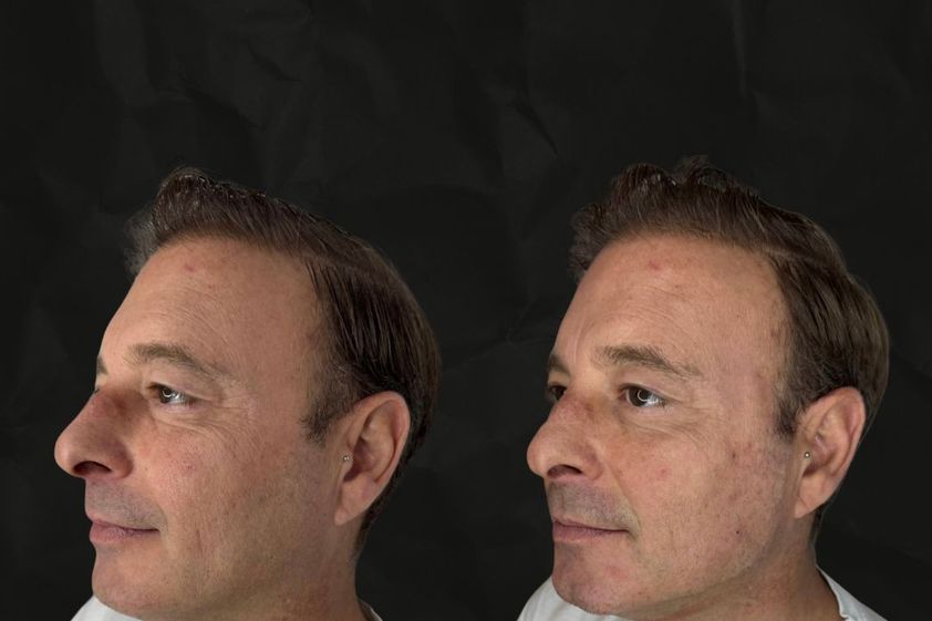 Marcación mandibular antes y después - 879885