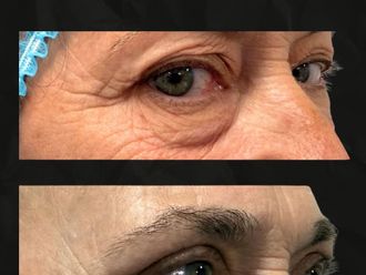 Blefaroplastia antes y después - 879887