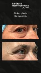 Blefaroplastia