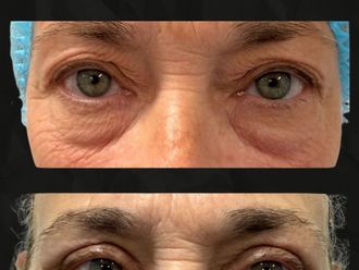 Blefaroplastia antes y después - 879888