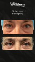 Blefaroplastia