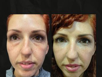 Eliminación ojeras antes y después - 879889