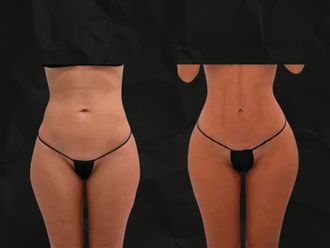 Liposucción antes y después - 879891