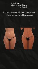Liposucción asistida por ultrasonido