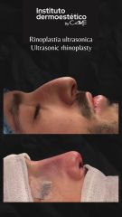 Rinoplastia Ultrasonica