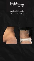 Abdominoplastia