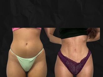 Liposucción antes y después - 879898