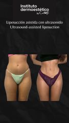 Liposucción asistida con ultrasonido