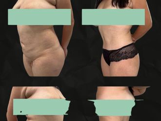 Liposucción antes y después - 879899