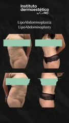 Lipoabdominoplastia