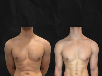 Liposucción antes y después - 879900