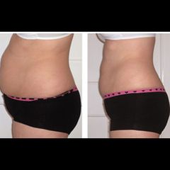 Laserlipo