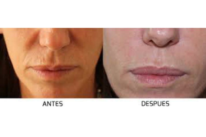 Rellenos faciales antes y después - 554482