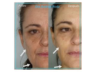 Antes y después  Rejuvenecimiento facial