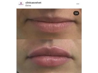 Antes y después micropigmentación labios