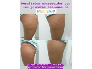 Antes y después Mesoterapia