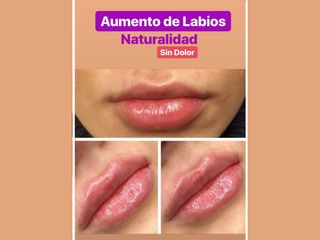 Antes y después Aumento de labios