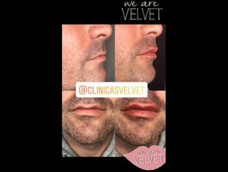 Aumento labios - 636422