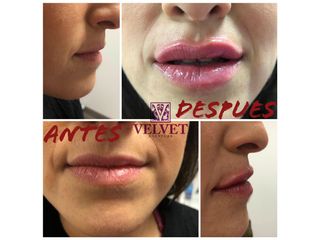 Antes y después Aumento de labios