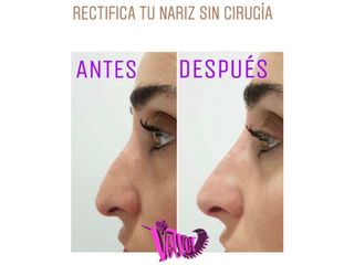 Antes y después Rinomodelación - Clínicas Velvet