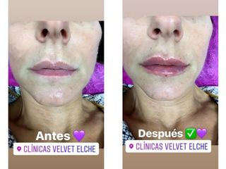 Antes y después Aumento de labios