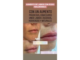 Antes y después Aumento de labios