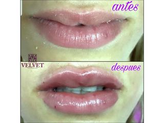 Antes y después Aumento de labios