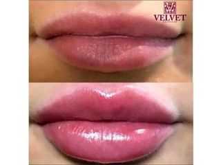 Antes y después Aumento de labios