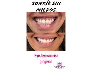 Antes y después Aumento de labios