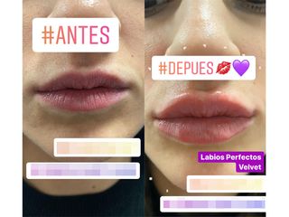 Antes y después Aumento de labios