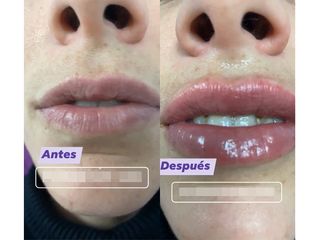 Antes y después Aumento de labios