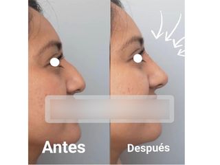 Antes y después Rinomodelación