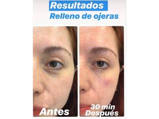 Antes y después Eliminación de ojeras