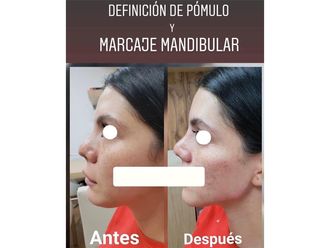 Rellenos faciales - 661125