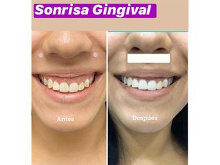 Antes y después Sonrisa Gingival