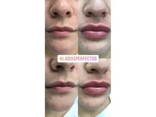 Antes y después Aumento de labios - Clínicas Velvet