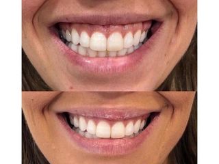 Antes y después Sonrisa gingival - Clínicas Velvet