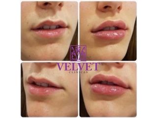 Antes y después Aumento de labios - Clínicas Velvet