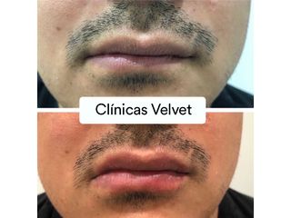 Aumento de labios - Clínicas Velvet