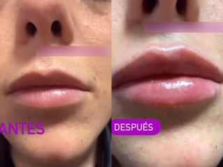 Aumento de labios - Clínicas Velvet