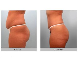 Antes y después Lipoescultura
