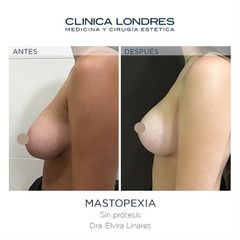 Mastopexia - Clínica Londres