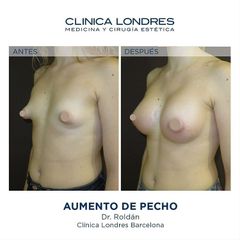Aumento de pecho - Clínica Londres