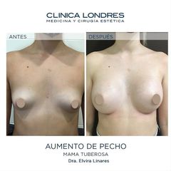 Aumento de pecho - Clínica Londres