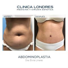 Abdominoplastia - Clínica Londres