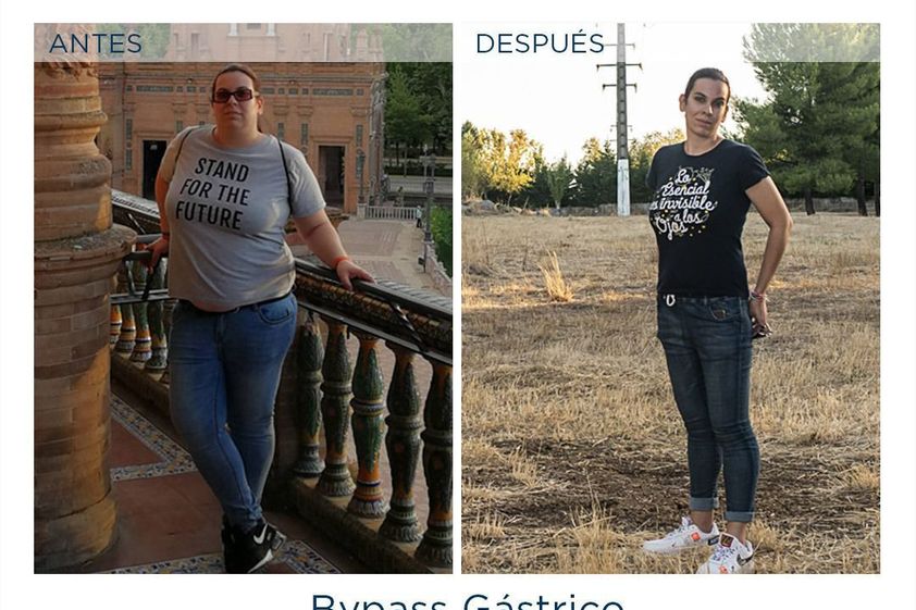 Banda gástrica antes y después - 791806